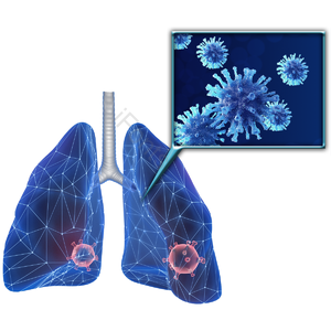 3D 肺炎 感染 菌 新冠病毒 流行病预防 健康 医疗护理